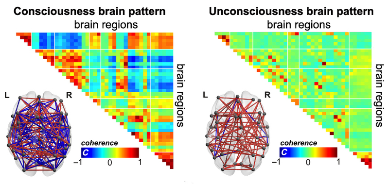 Pattern 1, left, can be distinguished from pattern 4, right, by the complexity and amount of connections between neurons in certain brain regions important for cognition, the authors say.